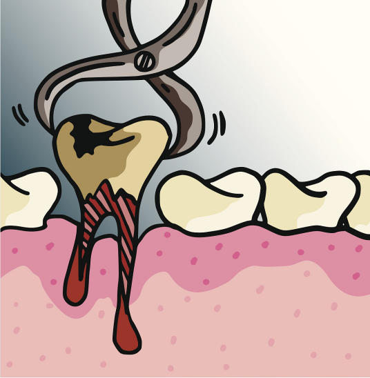 拔牙（口腔科治疗技术）