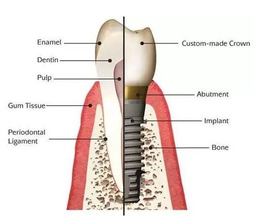 HT dental implant