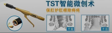 TST微创术