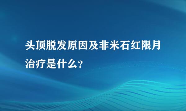 头顶脱发原因及非米石红限月治疗是什么？