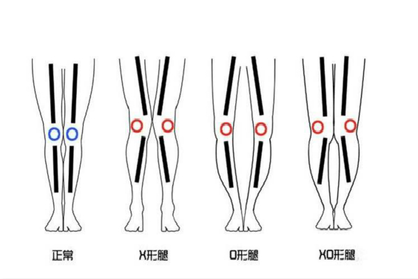 如何判断xo型腿 图片