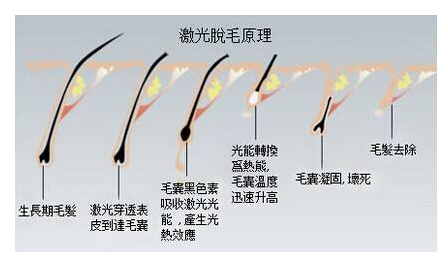 怎么永久去除汗毛？