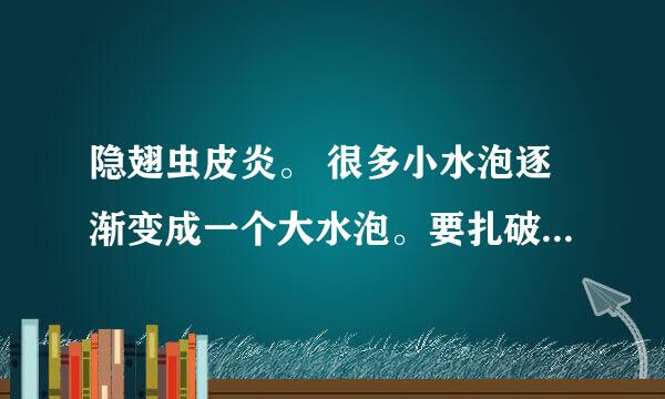 隐翅虫皮炎。 很多小水泡逐渐变成一个大水泡。要扎破吗？ 感觉不扎药涂了没用。。