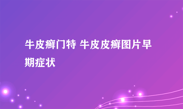 牛皮癣门特 牛皮皮癣图片早期症状