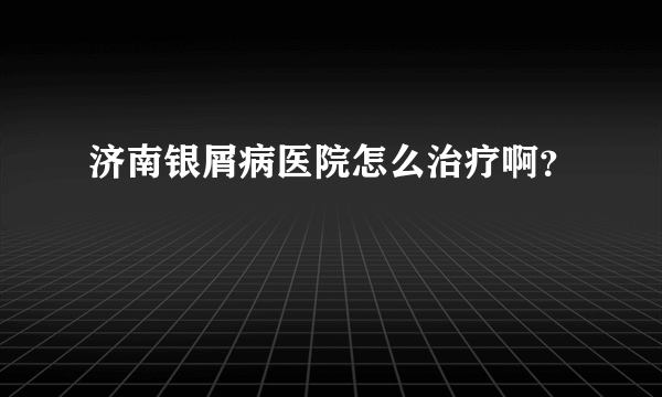 济南银屑病医院怎么治疗啊？