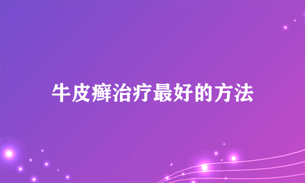 牛皮癣治疗最好的方法