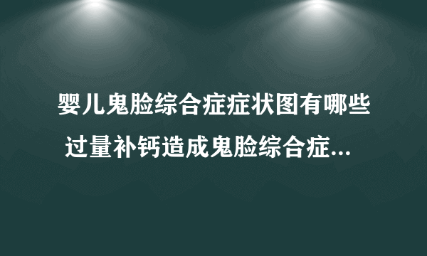 婴儿鬼脸综合症症状图有哪些 过量补钙造成鬼脸综合症的危害是什么