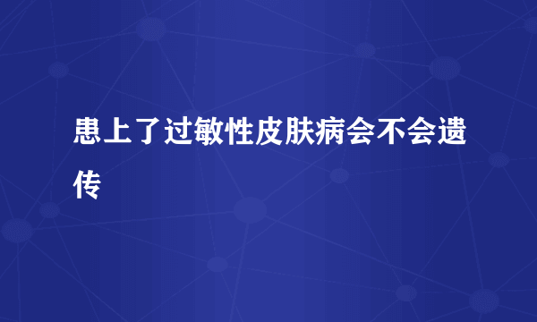 患上了过敏性皮肤病会不会遗传